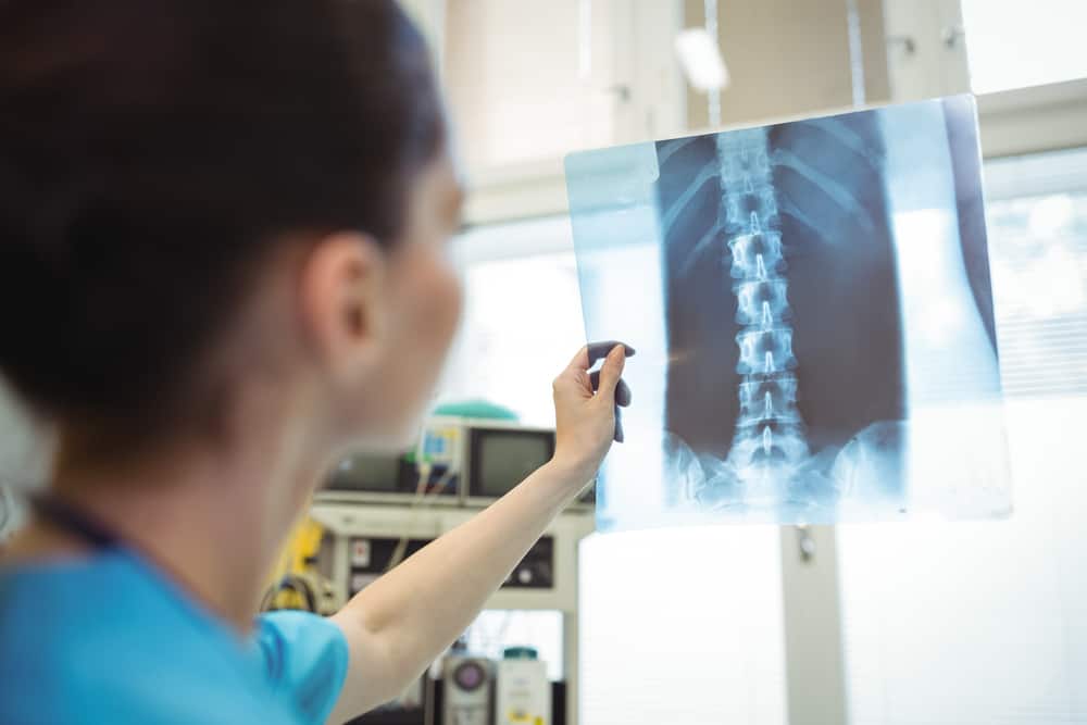 Female nurse examining x-ray report of a spinal cord injury