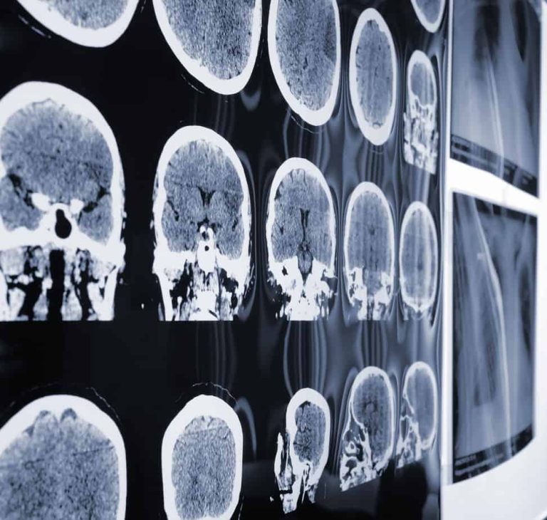 Traumatic Brain Injury Lawyers of Seattle can help with your case.